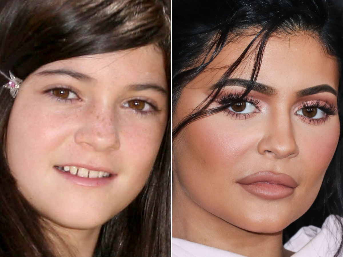 Kylie Jenner smile comparison